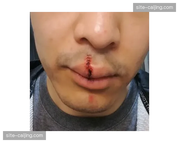 韦林顿嘴唇缝合十五针 首轮激烈对抗致三名球员重伤缝针